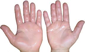 How to Get Rid of Clammy Hands Fast: 5 Quick Remedies for Sweaty Hands ...